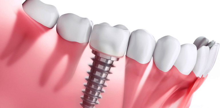dental implants in pimple saudagar